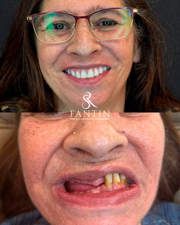 Antes e depois de dentes fixos em um dia com carga imediata — Fantin Odonto