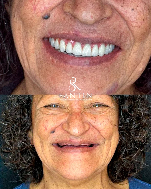 Antes e depois: trocar dentadura por prótese fixa sobre implante — Fantin Odonto Zona Norte SP